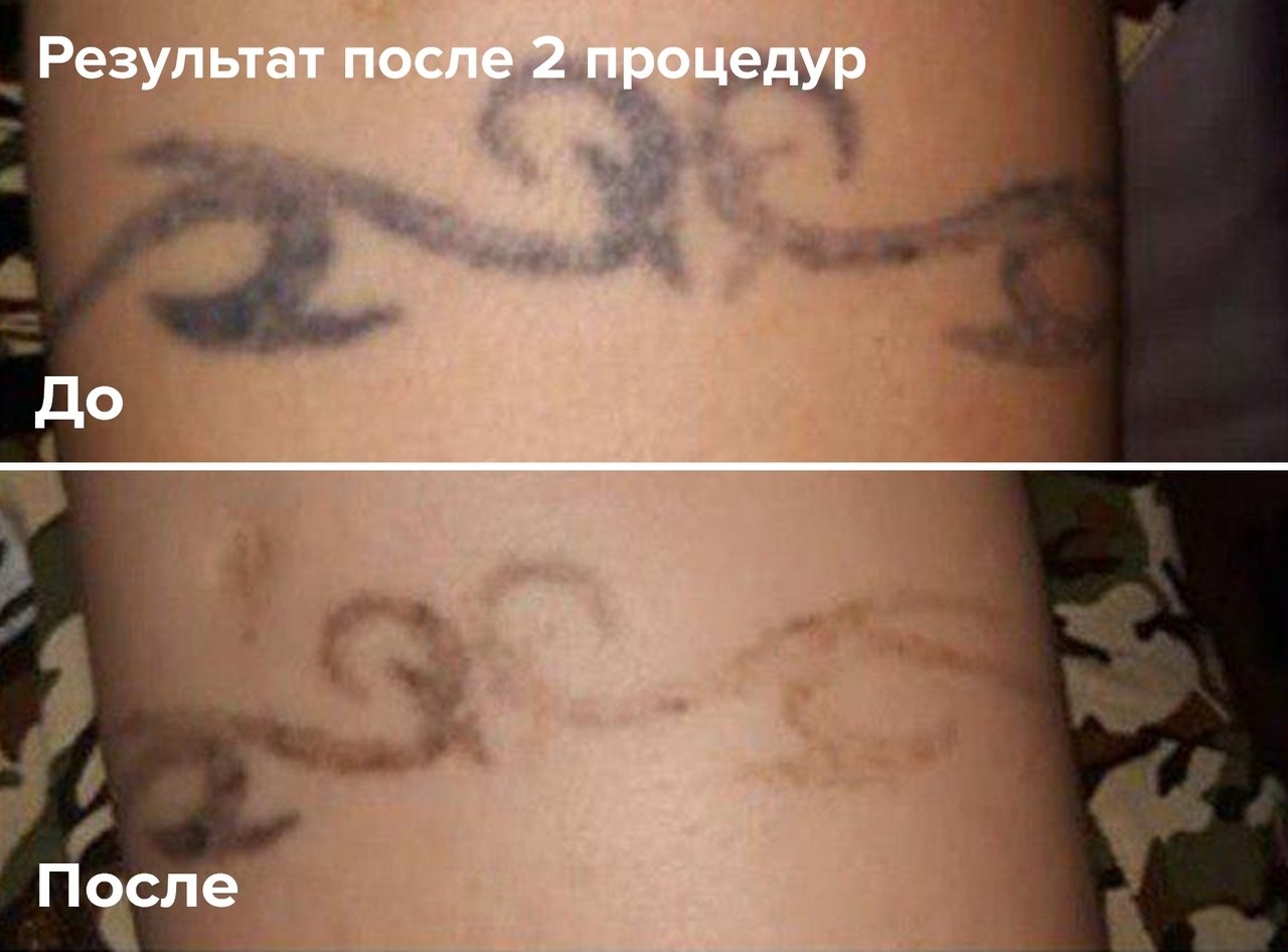 Остаются ли шрамы после лазерного удаления тату