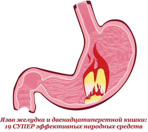 Язва желудка и двенадцатиперстной кишки: 19 СУПЕР эффективных народных средств. 1. При язве желудка ...