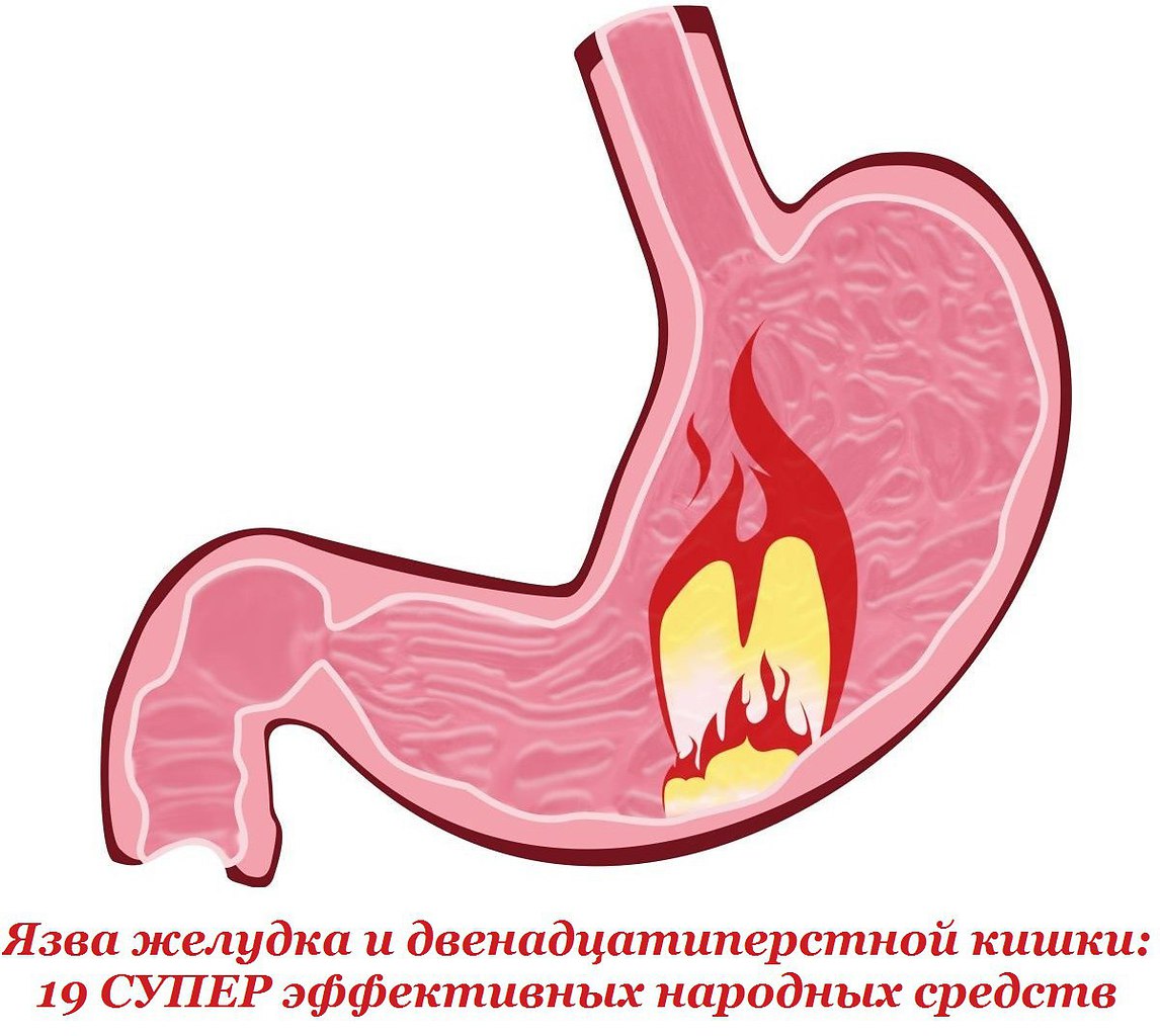 Язва желудка и двенадцатиперстной кишки: 19 СУПЕР эффективных народных средств. 1. При язве желудка ...