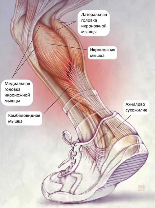 Миозит икроножной мышцы