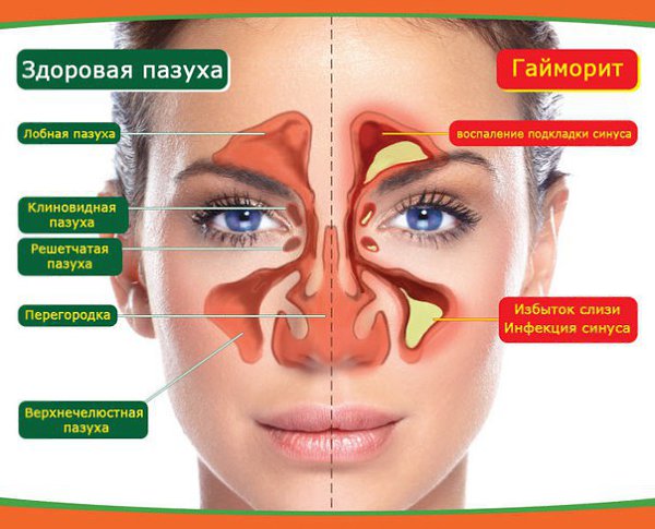 Как вылечить гайморит в домашних условиях/ ПРОВЕРЕНО НА СЕБЕ