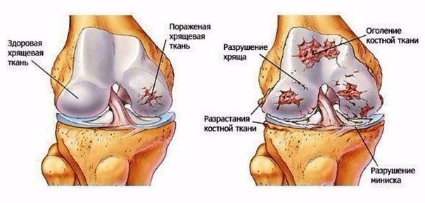 Чудо рецепт от боли в суставах!! Опробовано, есть результат!!! Рецепт такой: покупаете в любом ...