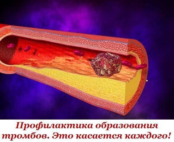 Профилактика образования тромбов. Это касается каждого! Инфаркт, инсульт, тромбофлебит, варикозное ...