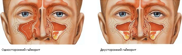 РЕЦЕПТ ОТ ГАЙМОРИТА.Наступила весна, и, как следствие, приходят простудные заболевания, обостряются ...