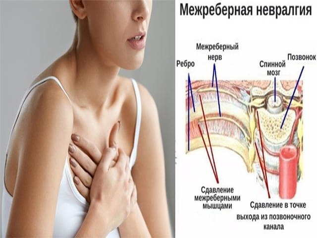 МЕЖРЕБЕРНАЯ НЕВРАЛГИЯ — это патология, заключающаяся в сдавливании и (или) раздражении межреберных ...