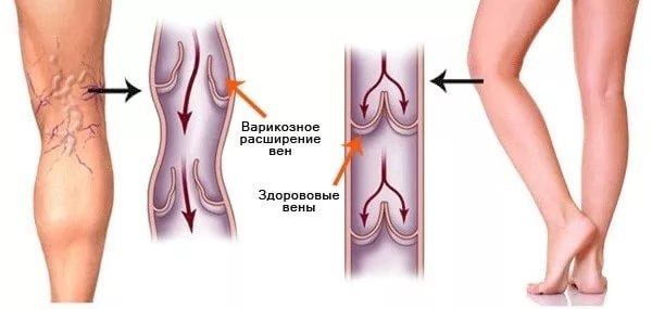 Гимнастика для сосудов.Варикозное расширение вен — болезнь, которой сегодня подвержены женщины ...