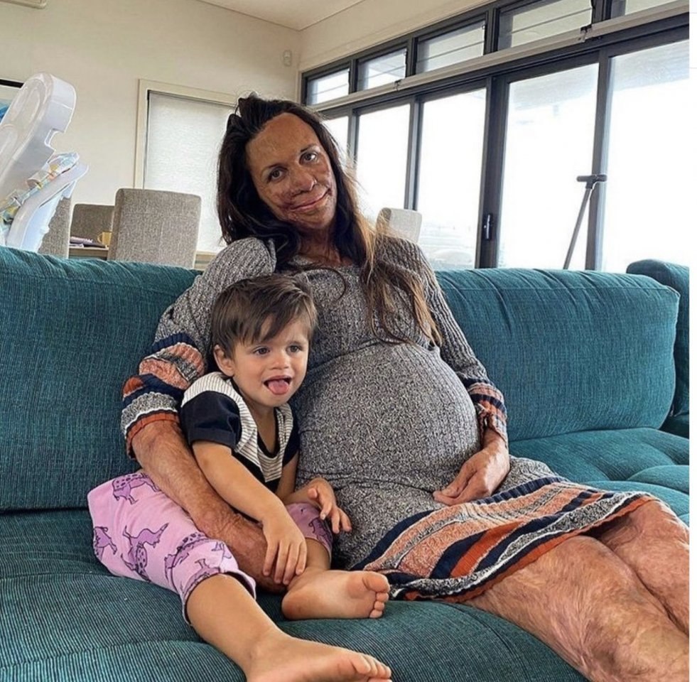 Жeнщина получила oжоги 90% тeла - 2