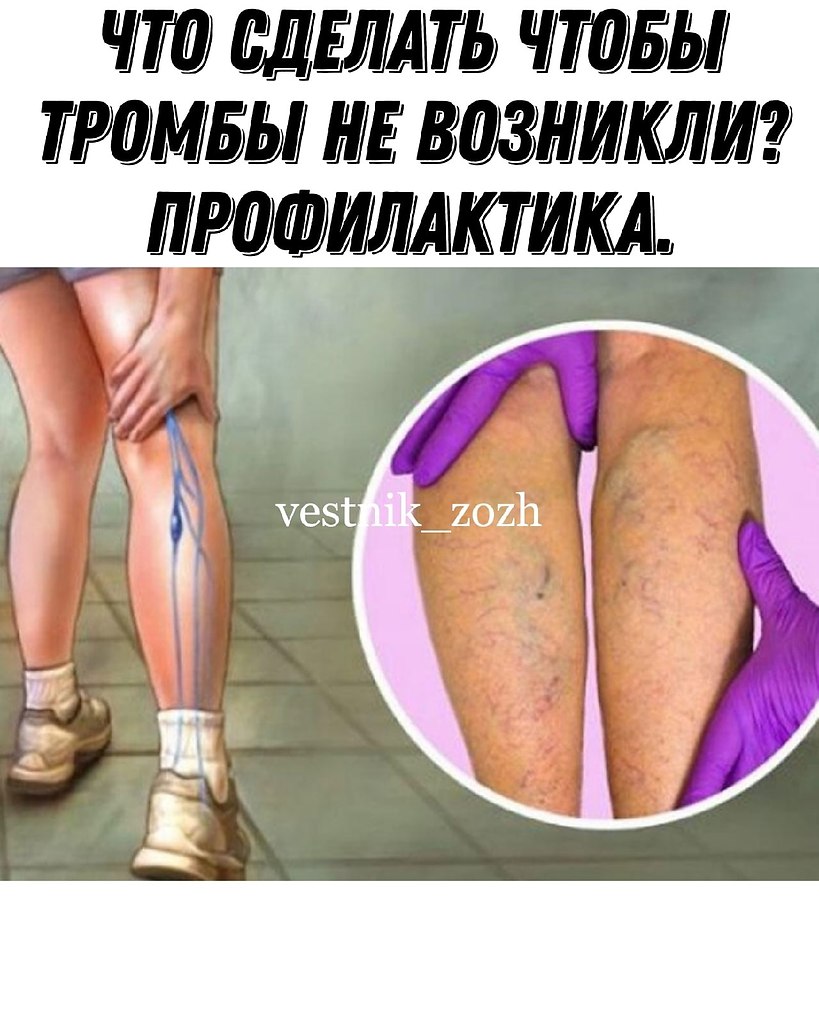 Что сделать чтобы тромбы не возникли? Профилактика. Некоторые знают, что густую кровь надо ...