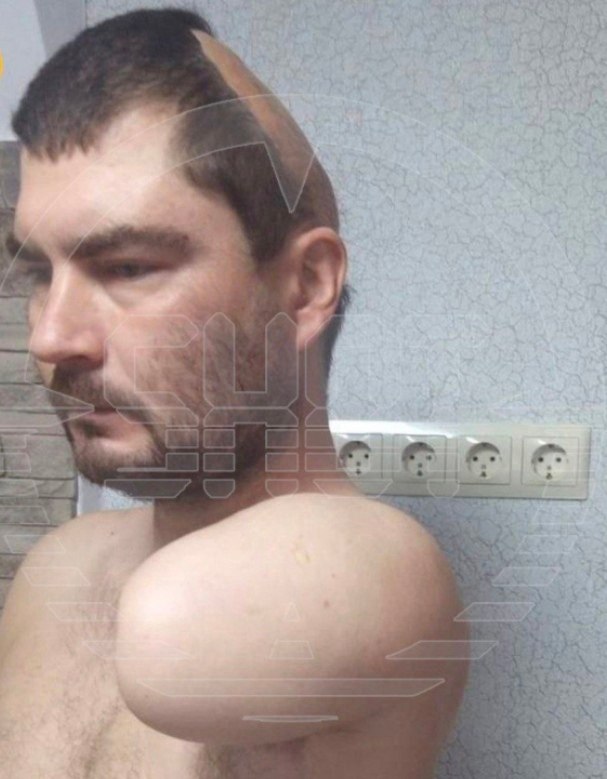 Житель Краснодарского края теряет руку и череп из-за несчастного случая, теперь он борется за свои ...
