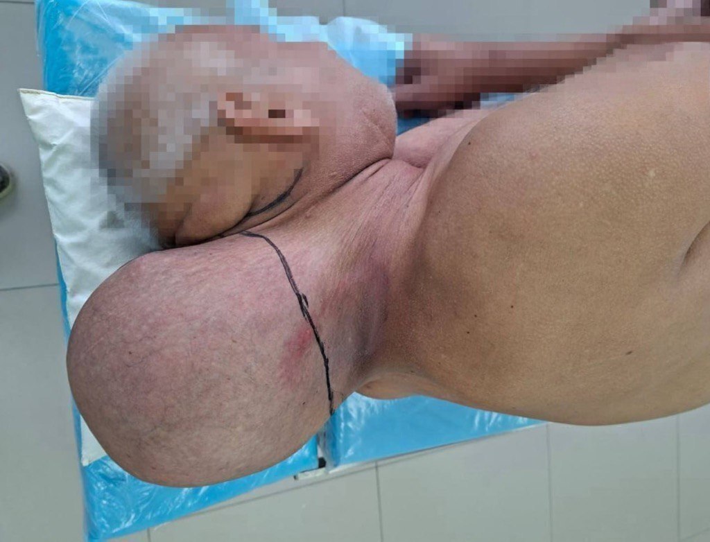 Вторую голову отрастил себе 65-летний дед из Кирова — мужик 16 лет игнорировал громадную опухоль и ...