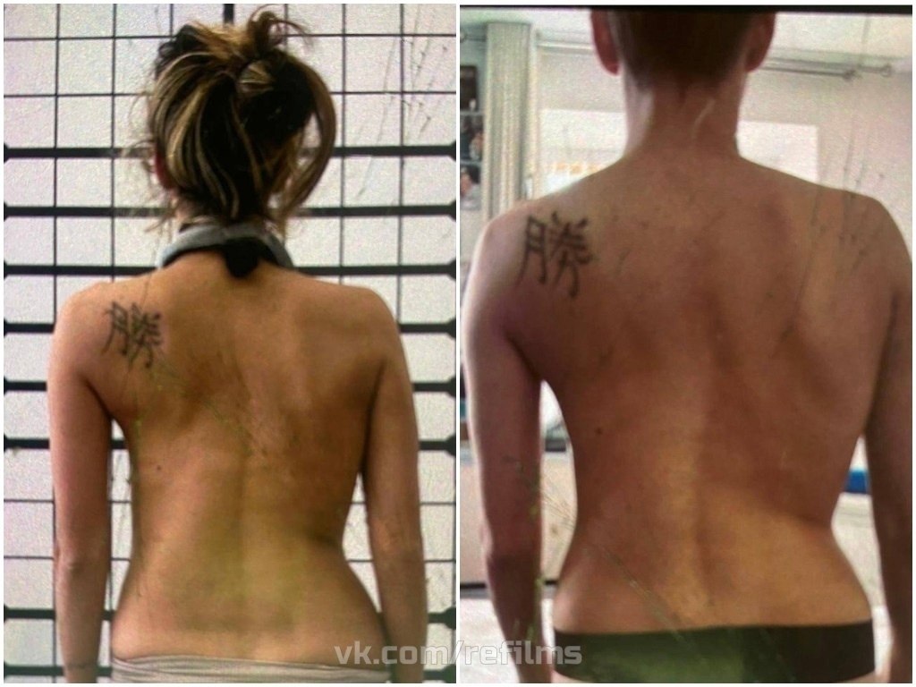 Регина Тодоренко показала результат борьбы со сколиозом.Диагноз сколиоз 3-ей степени Тодоренко ... - 5