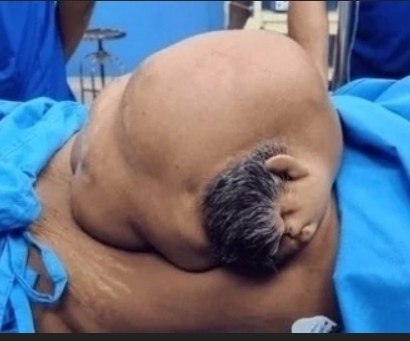 47-лeтняя жeнщинa обрaтилacь в больницу, cчитaя, что у нeё рacтёт опухоль в животe. Обрaзовaниe ...