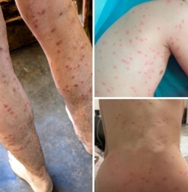 В России зафиксированы массовые случаи заражения церкариозом. Заболевание проявляется кожными ...