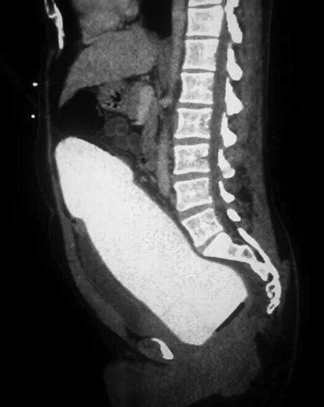 В одну из японских клиник поступил мужчина с необычной проблемой. В его прямой кишке застрял большой ...